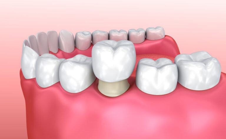 Kroontand - DentUrgent