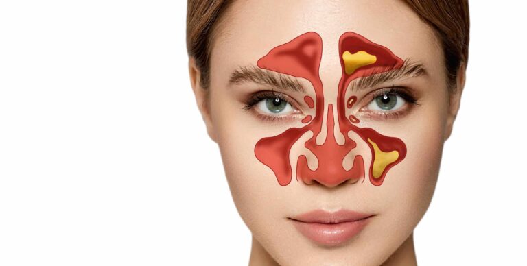 Sinusitis en tandpijn